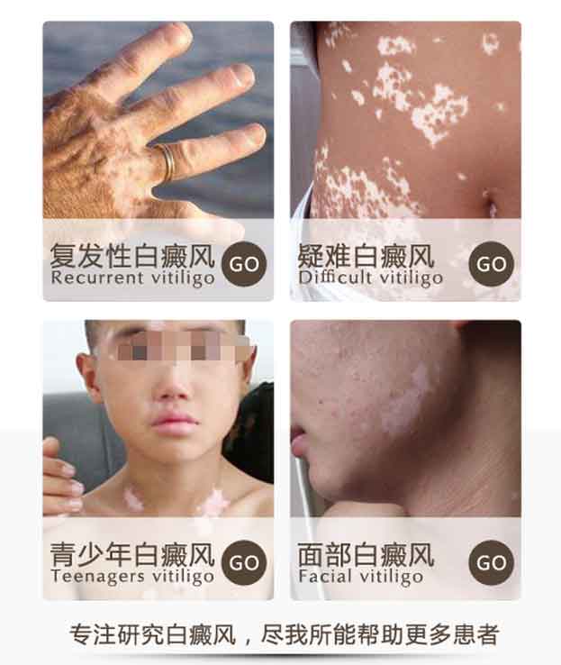 白癜风治疗