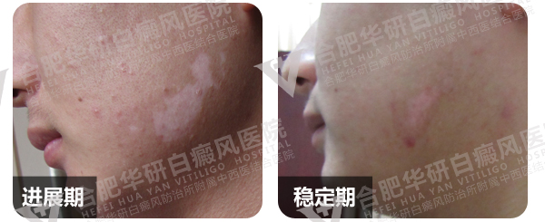 白癜风治疗，合肥白癜风医院