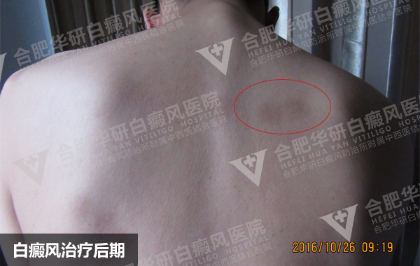 背部白癜风用308激光照射可以吗