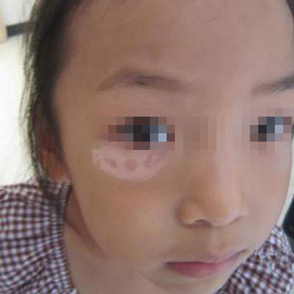 4岁孩子眼角长白斑是什么病