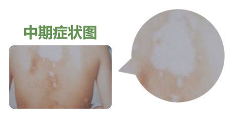 合肥华研白癜风医院的费用贵吗？