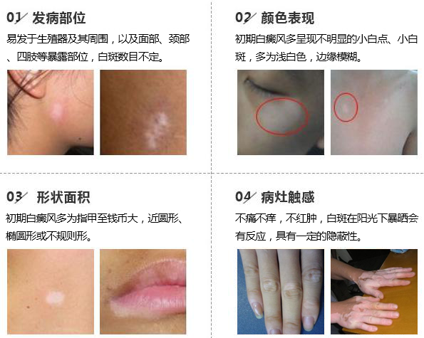 合肥白癜风医院哪家好