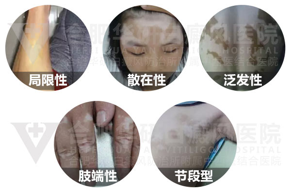 白癜风扩散