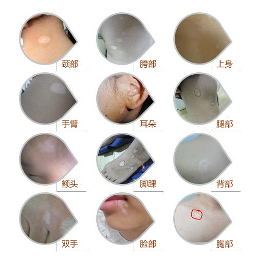 白癜风各个部位发病的原因?