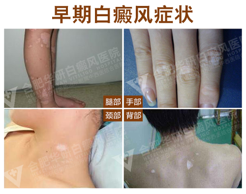 白癜風(fēng)早期癥狀有哪些