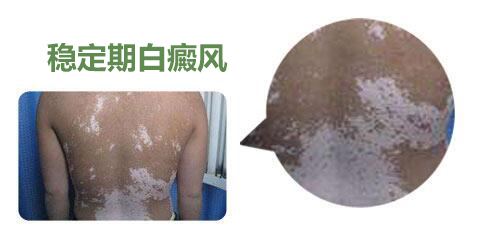 合肥华研专治白癜风