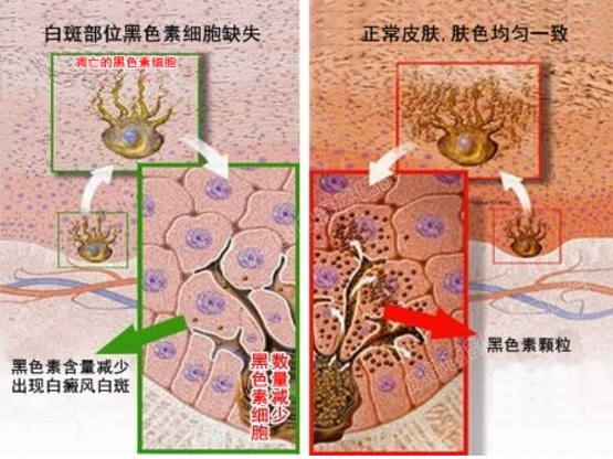 合肥最好的白癜风医院