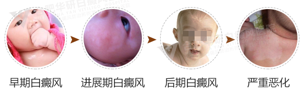 婴儿患白的外在因素有哪些?