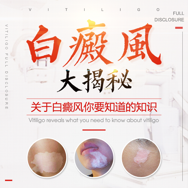 青少年白癜风初期明显症状有哪些