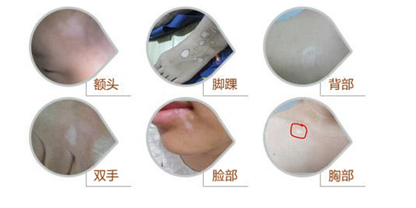 合肥华研白癜风医院在哪