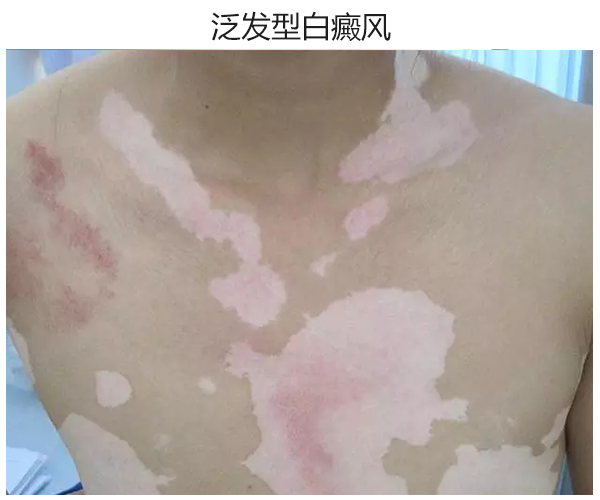 杭州治白癜风,末期白斑病疾病的症状