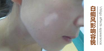 儿童面部白斑病是咋形成的?