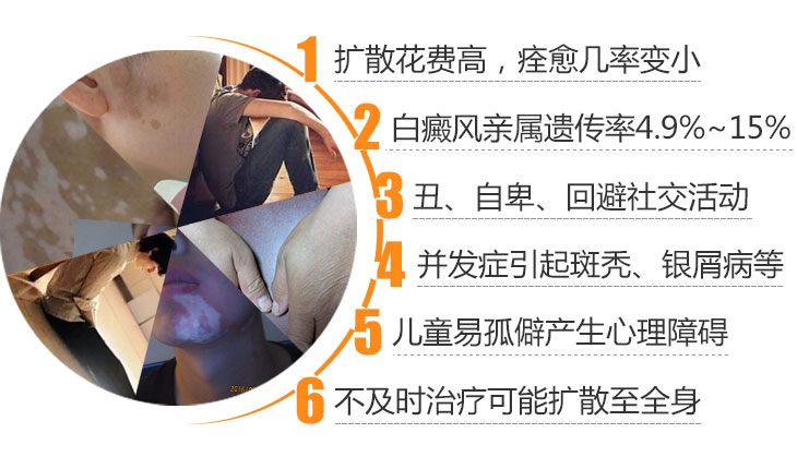 白癜风会带来哪些方面的危害