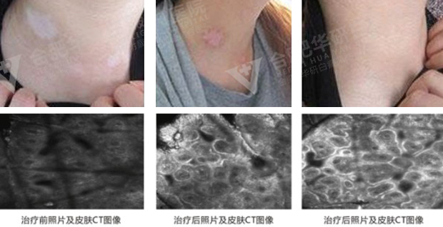合肥华研白癜风医院在哪