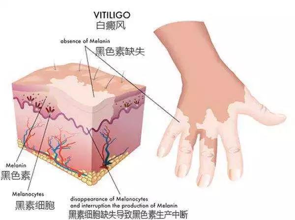 手上有白斑能治疗吗?