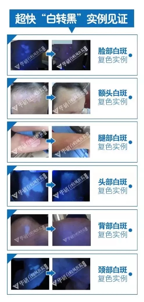 哪家醫(yī)院能治療白殿瘋