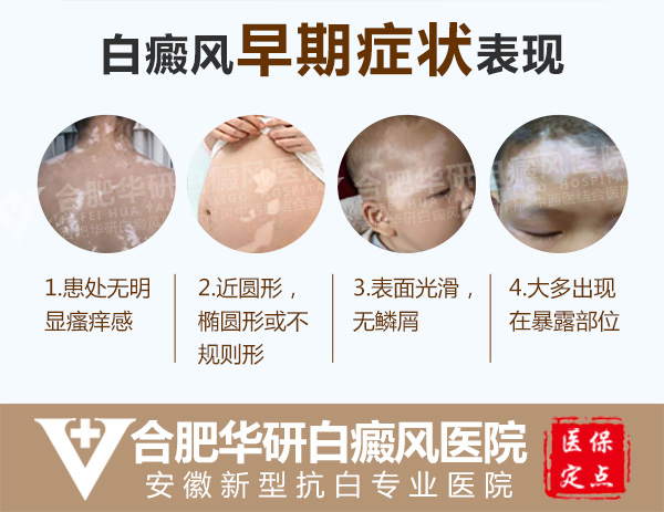白癜风发病早期症状和特点都有哪些