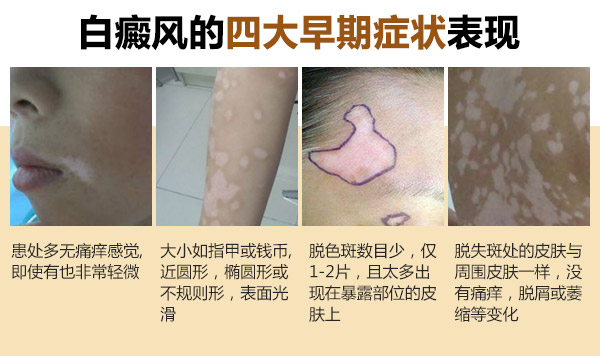 合肥华研白癜风医院好吗