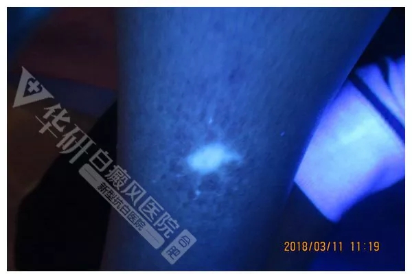 合肥最好的白癜風(fēng)醫(yī)院