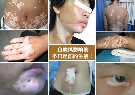 白癜風(fēng)有哪些危害