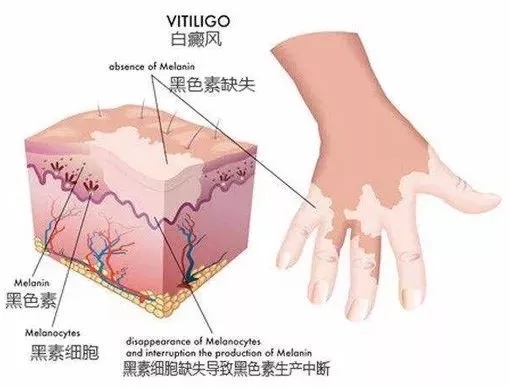 合肥白癜风医院哪家好