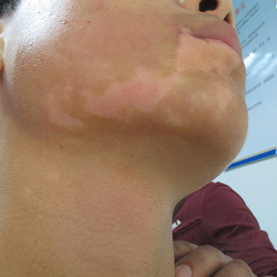 芜湖白癜风患者需要怎样护理皮肤