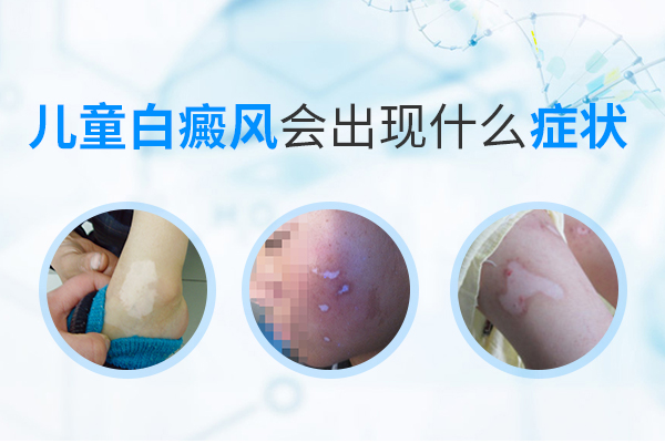 儿童白癜风容易发生在什么部位?