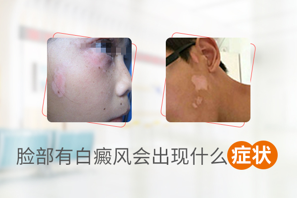 脸上一块一块的白斑不会是白癜风吧?