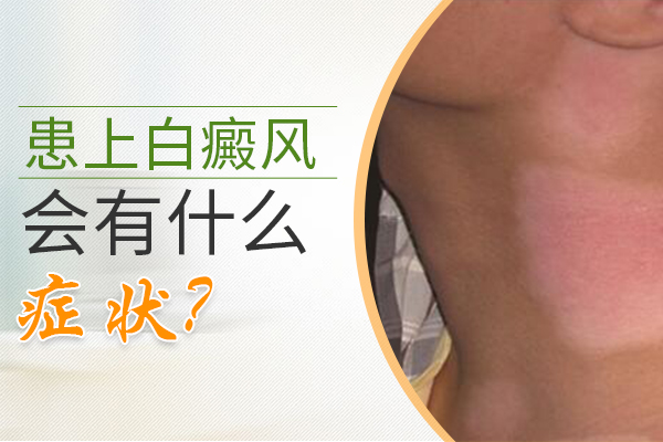 手部白癜风的早期症状有哪些?