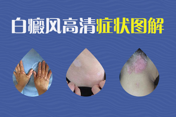 白癜风加重会出现什么症状