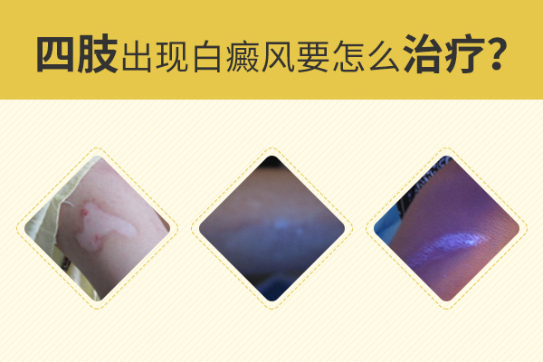 台州有几个白癜风专科医院 如何治疗手部白斑