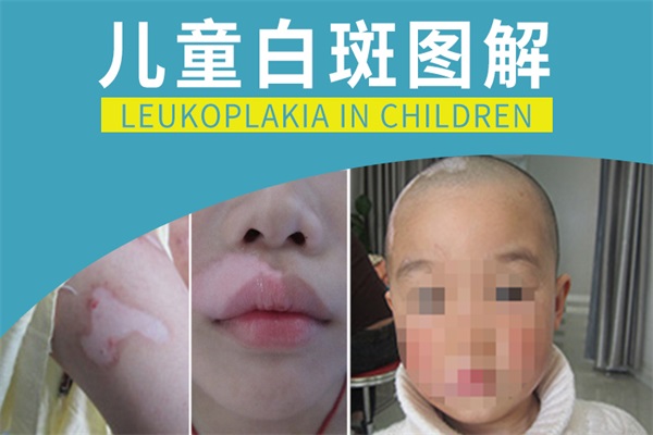 小孩嘴角有白斑是怎么回事，该如何诊断?