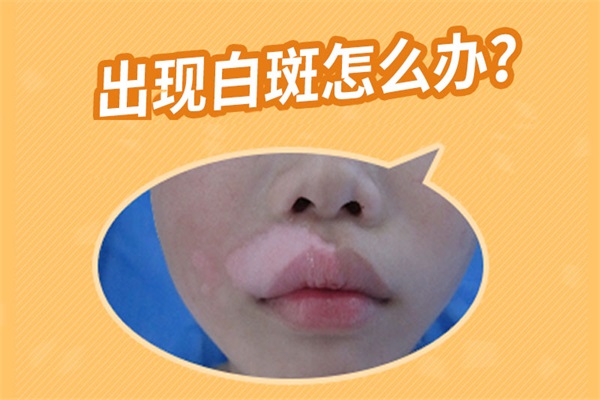 女性嘴唇早期的白癜风怎么治疗?