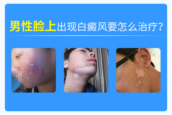 脸上起白癜风在合肥怎么治?