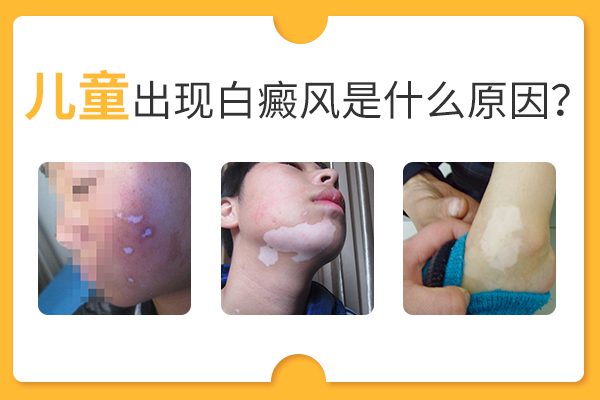 儿童耳朵为什么会患有白癜风?
