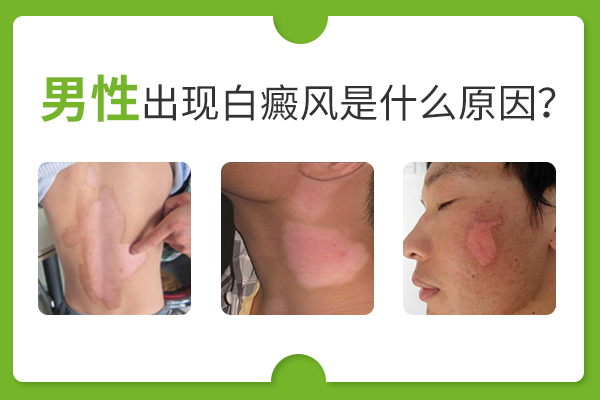 男性出现白癜风是什么原因?