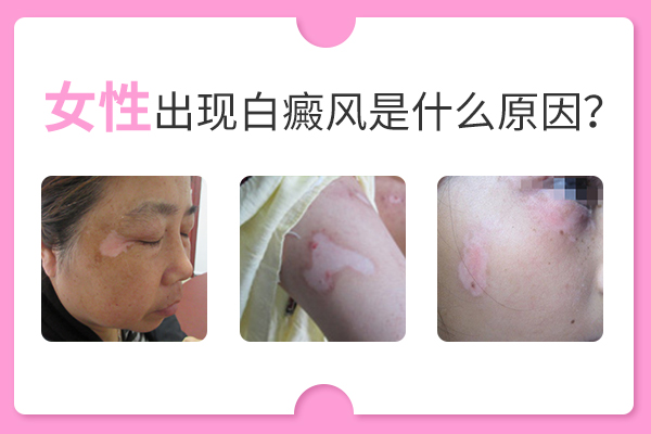 中年女性为何长白癜风？