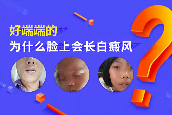 脸上为什么会比较容易长白癜风疾病?