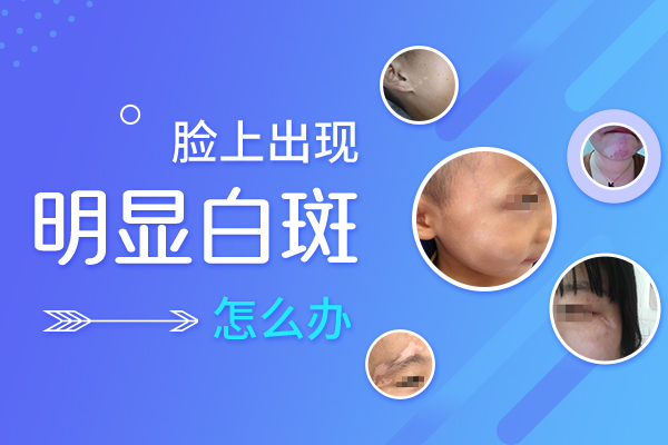 杭州白癜风专科医院 外伤性白癜风的症状有哪些