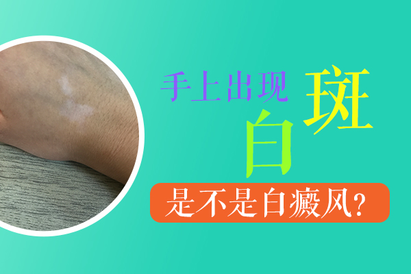 杭州看白癜风 手部出现白癜风的原因是什么呢
