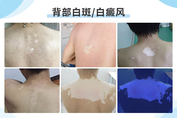 背部大面积白癜风怎么办?