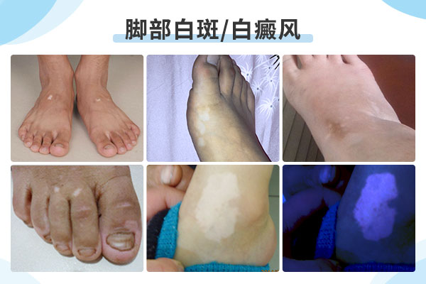 脚上长的白斑是不是白癜风?