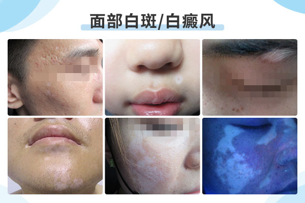 面部出现白癜风都有什么症状?