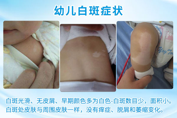 你了解幼儿白癜风吗