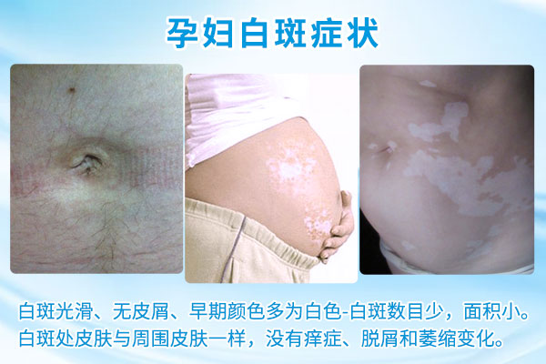 孕妇白癜风有那些症状