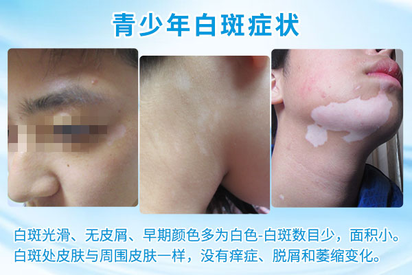 杭州看白斑哪家好 怎样有效的治疗青少年白癜风
