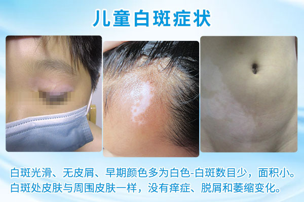 怀化怎么能治疗好孩子的白癜风