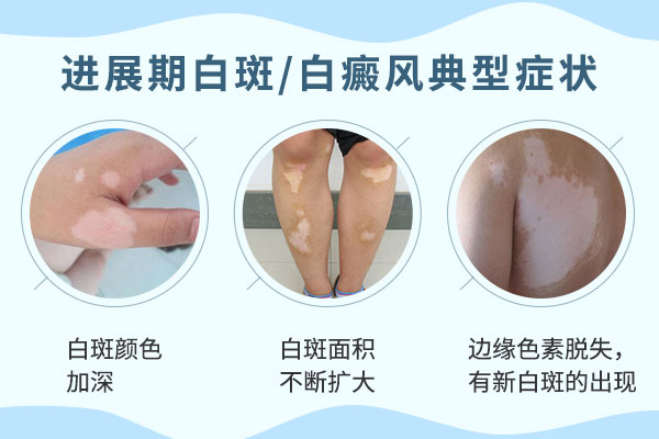 那晚期白癜风的危害有哪些呢?